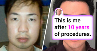 A Man Leaves People Speechless with Remarkable Results from 10 Years of Plastic Surgery