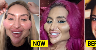 See How the Woman Who Now Has the World’s Biggest Cheeks Looked Like Before She Changed Dramatically