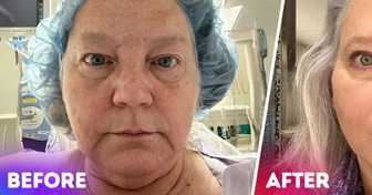 16 People Who Opted for Plastic Surgery and Are Now Thrilled with the Results