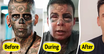 Man Who Had 95% of His Body Tattooed Reveals Stunning Results of Removal Surgery