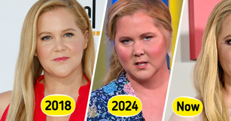 Amy Schumer Reveals That Internet Users Helped Her Find the Cause of Her “Moon Face”