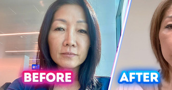 15 People Who Chose Plastic Surgery and Couldn’t Be Happier with Their New Looks