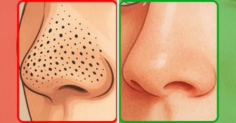 8 Simple Home Tricks You Can Use to Remove Blackheads and Whiteheads Naturally
