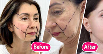 “She Looks 20 Years Younger!” Woman, 49, Leaves People Speechless After Revealing Surgery Results