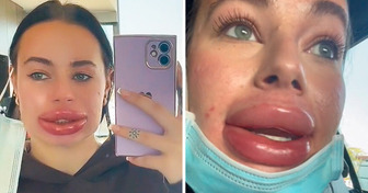 A Young Woman Went Through a Nightmare and Now Wants to Warn Everyone Who Dreams of Plump Lips