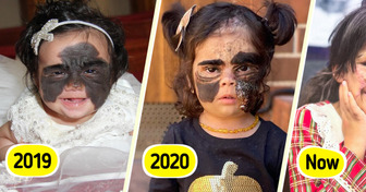 Girl Was Called “Monster” for Her “Batman” Birthmark — Now She Looks Completely Unrecognizable