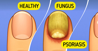 8 Silent Everyday Triggers That Could Be Fueling Psoriasis