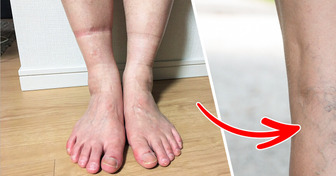 4 Health Problems Your Feet Could Be Telling You Through Sock Marks