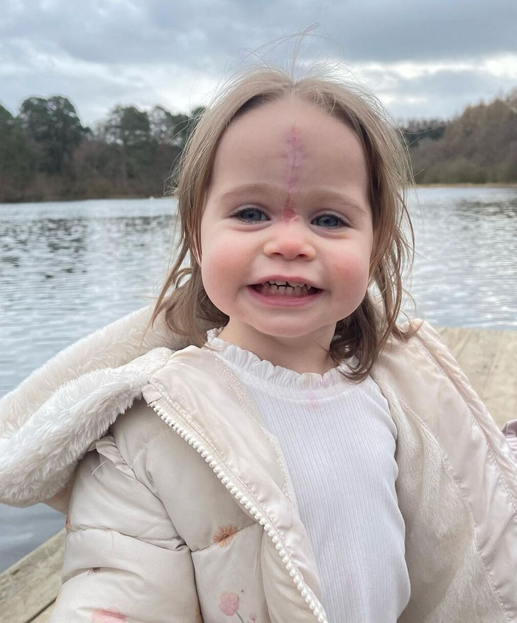 A young kid by the lake with a scar between her eyes going up to her forehead.