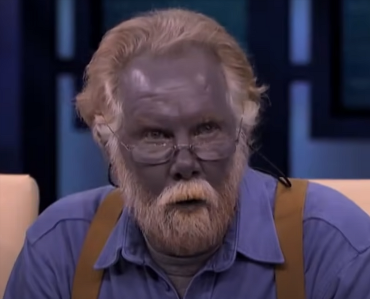 Meet 'Papa Smurf', The Man Whose Skin Turned Blue After Consuming Dietary  Supplements - News18